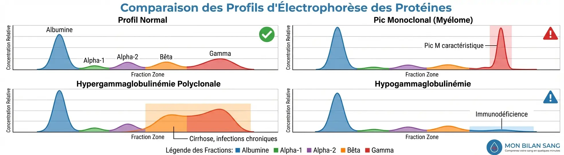Comparaison des profils d'électrophorèse protéique : tracé normal avec cinq fractions distinctes versus tracés pathologiques montrant pic monoclonal du myélome, hypergammaglobulinémie polyclonale et hypogammaglobulinémie